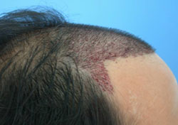 Affordable Hair Transplant