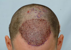 After Hair Transplant Surgery