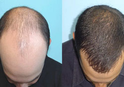 After Hair Transplant