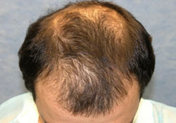 Best Hair Transplant in the World