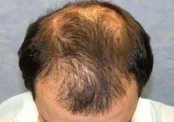 Best Hair Transplant in the World Best Hair Transplant in the World