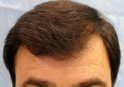 Best Hair Transplant