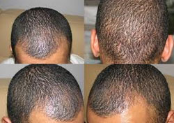 Black Hair Transplant