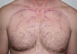 Body Hair Transplant