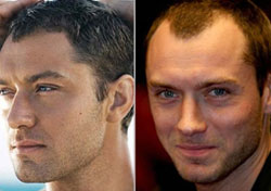 Celebrity Hair Transplant