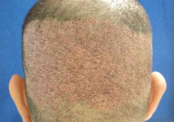 Cheap Hair Transplant