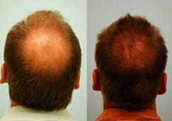 Cost of FUE Hair Transplant