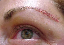 Eyebrow Hair Transplant Eyebrow Hair Transplant