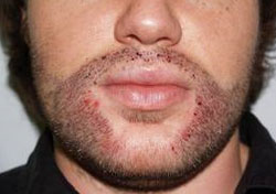 Facial Hair Transplant