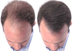 Follicle Hair Transplant