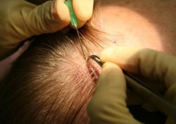 Free Hair Transplant Free Hair Transplant