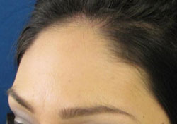 Frontal Hair Transplant