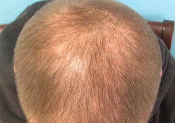 Hair Growth After Hair Transplant