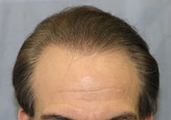 Hair Transplant Blogs