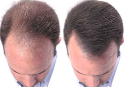 Hair Transplant Cloning