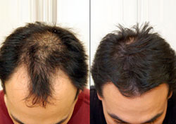 Hair Transplant Cost