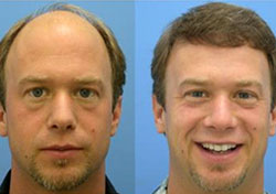 Hair Transplant FAQs