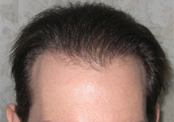 Hair Transplant for Black Men Hair Transplant for Black Men