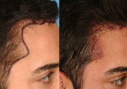 Hair Transplant for Thinning Hair