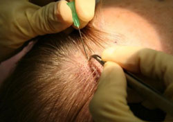 Hair Transplant Information