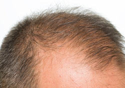 Hair Transplant Neograft