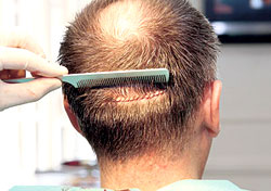 Hair Transplant Problems