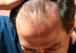 Hair Transplant Regrowth