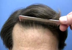 Hair Transplant Results