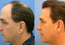 Hair Transplant Reviews