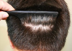 Hair Transplant Scarring