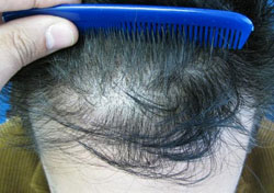 Hair Transplant Shock Loss