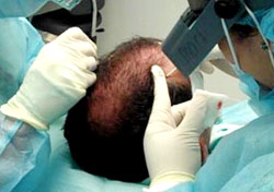 Hair Transplant Specialists