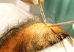 Hair Transplant Stem Cell