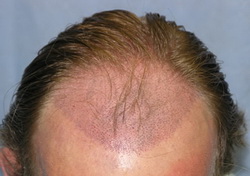 Hair Transplant