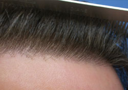 Hairline Hair Transplant