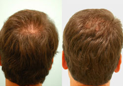 Male Hair Transplant