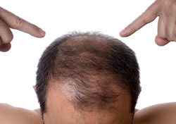 Hair Transplant