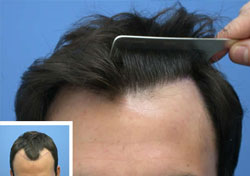 What is a Hair Transplant What is a Hair Transplant